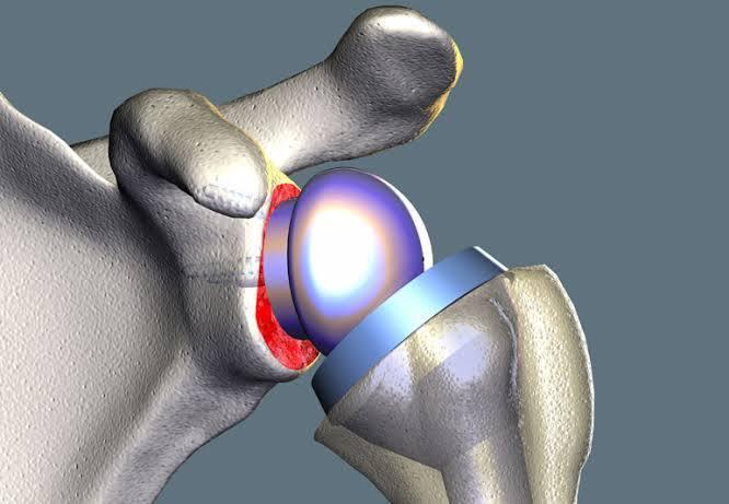 Shoulder Replacement at Medical Park