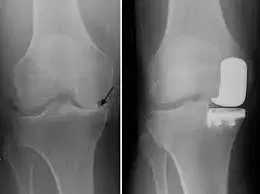 Unilateral Knee Replacement at Medical Park, Istanbul, Turkey