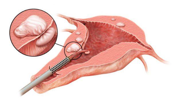 Laparoscopic Myomectomy at Artemis Hospital, Gurgaon