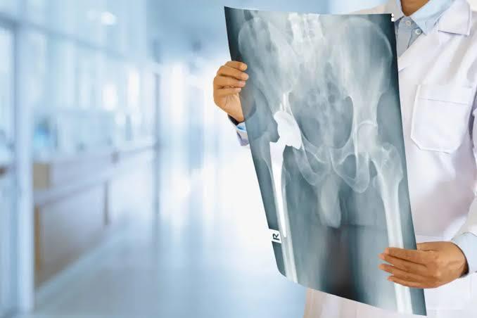 Bilateral Hip Replacement at Marengo Asia, Gurgaon, India