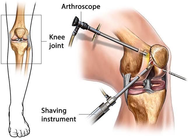 Knee Arthroscopy at Artemis, Gurgaon, India