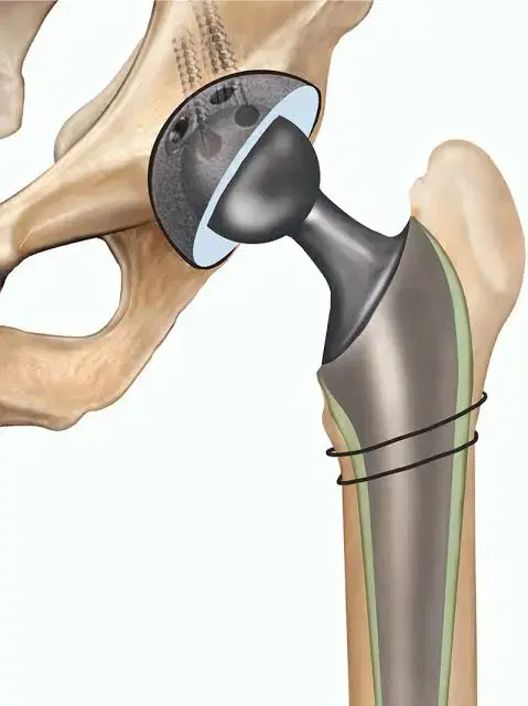 Bilateral Hip Replacement at Max, New Delhi, India