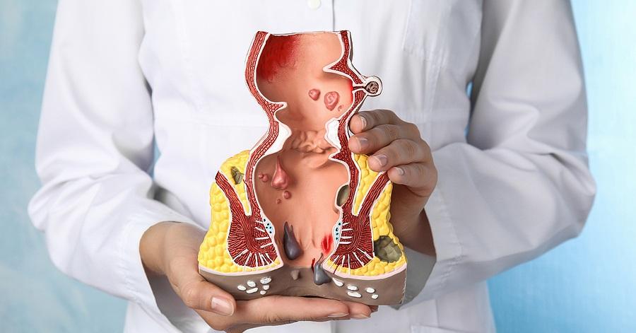 Hemorrhoidectomy Surgery at Saudi German Hospital, Dubai
