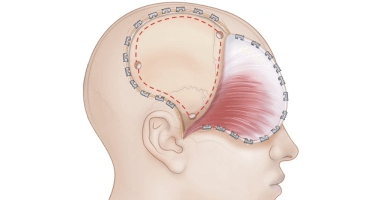 Craniotomy Surgery at Paras Hospitals, Gurgaon
