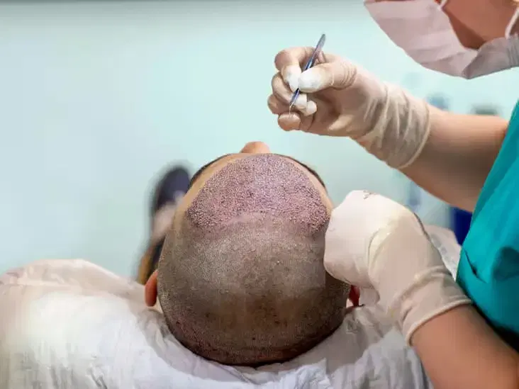 Hair Transplant (3500 grafts) and Stem Cell at Dr Hakan Clinic Istanbul
