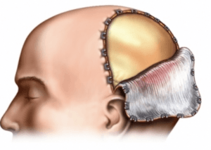 Craniotomy Surgery at Medical Park, Istanbul