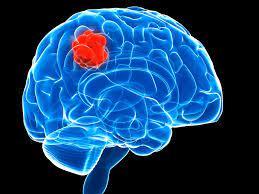 Brain Tumor Excision Surgery at Saudi German Hospital, Dubai
