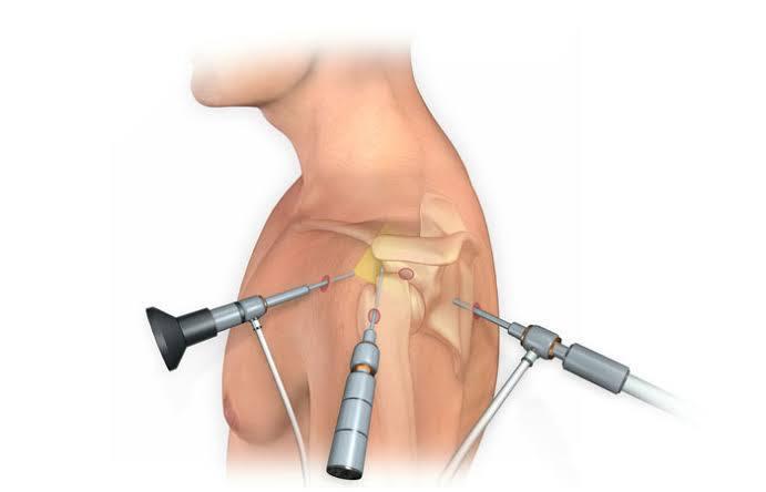 Shoulder Arthroscopy at Marengo Asia, Gurgaon, India