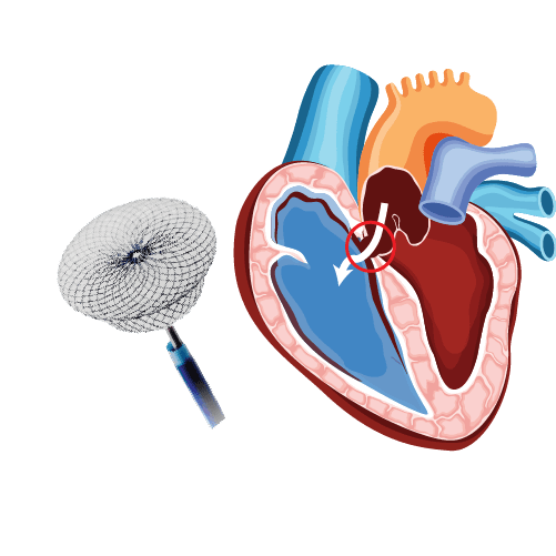 ASD/VSD Closure at Medicana Istanbul