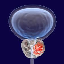 HOLEP Surgery at Medicana, Istanbul, Turkey