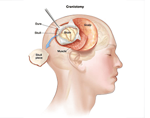 Craniotomy at Artemis Hospital, Gurgaon