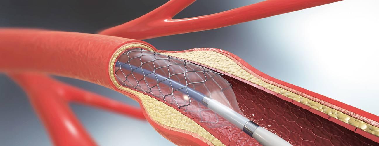 Coronary Angioplasty at FMRI, Gurgaon, India