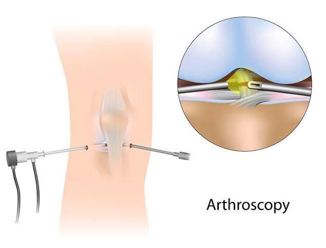 Knee Arthroscopy at Marengo Asia, Gurgaon, India