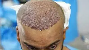 Hair Transplant at Dr. Hakan Clinic