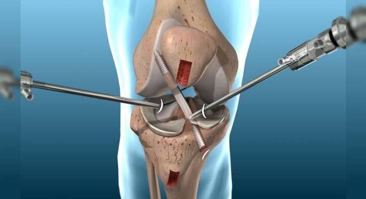 Knee Arthroscopy at Medicana, Istanbul, Turkey