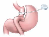 Gastric Banding at Saudi German Hospital, Dubai
