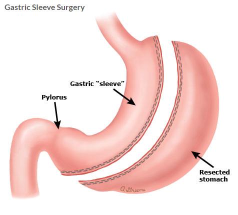 Gastric Sleeve Surgery at Asian Institute, Faridabad, India
