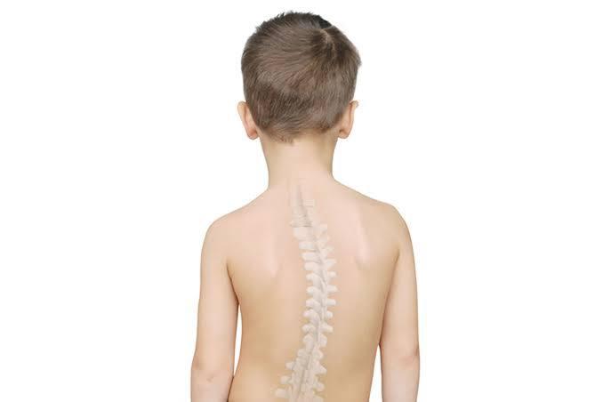 Scoliosis Spine Surgery at BLK-Max Super Speciality Hospital, New Delhi