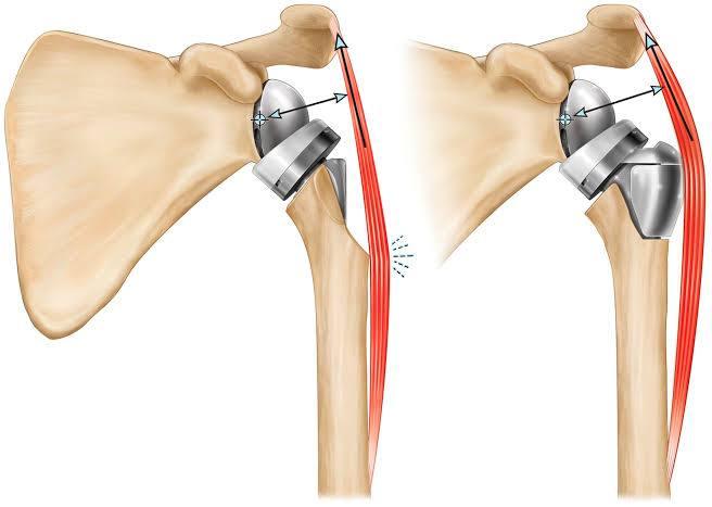 Shoulder Replacement at Saudi German