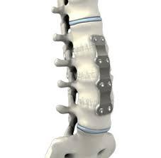 Spine Discectomy at Saudi German, Dubai, UAE
