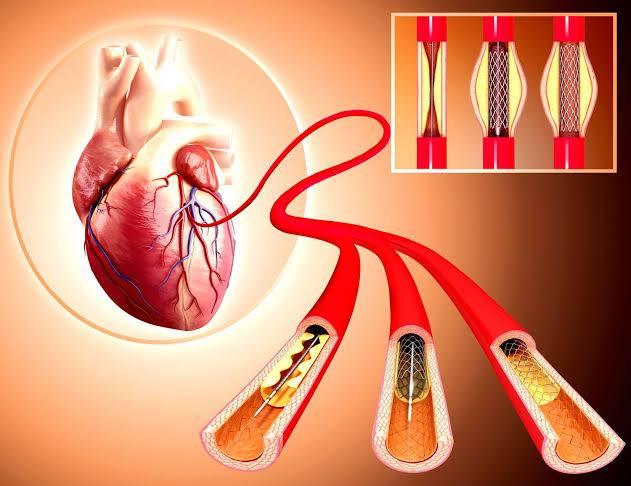 Coronary Angioplasty at Medicana Istanbul, Turkey