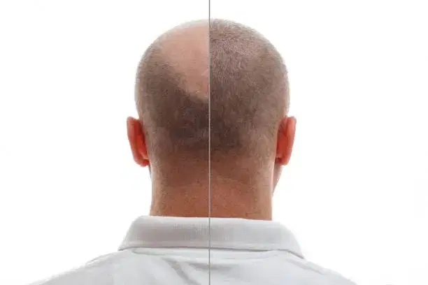 Hair Transplant at Long Hair Clinic - Yapita Health