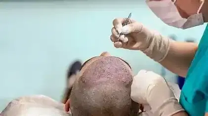 Hair Transplant at Dr Kaan Pekiner Clinic, Ankara, Turkey