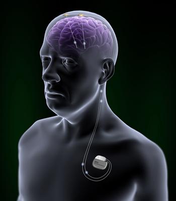Deep Brain Stimulation at American Hospital, Istanbul