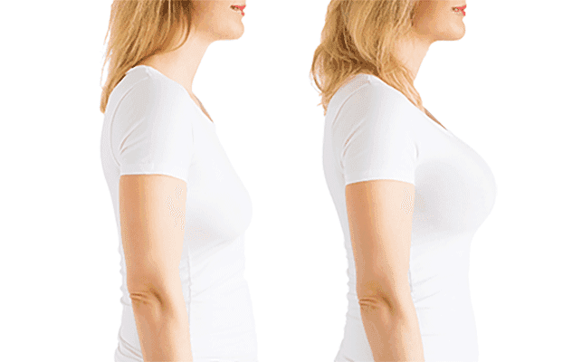 Breast Augmentation at Medicana, Istanbul, Turkey