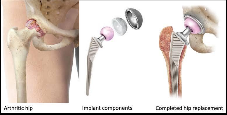 Bilateral Hip Replacement at Medicana, Istanbul, Turkey