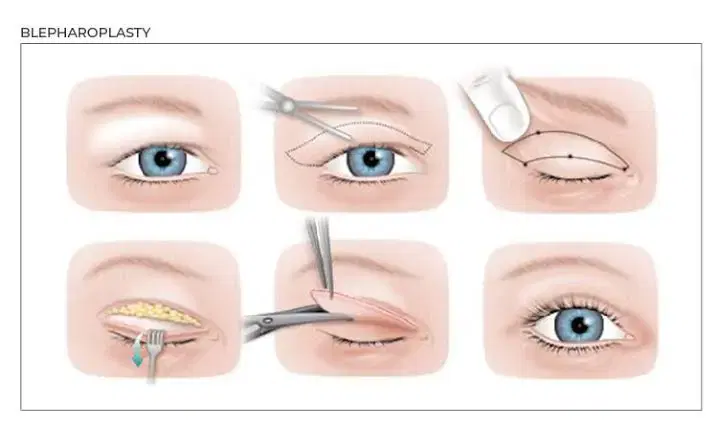 Blepharoplasty at Medicana