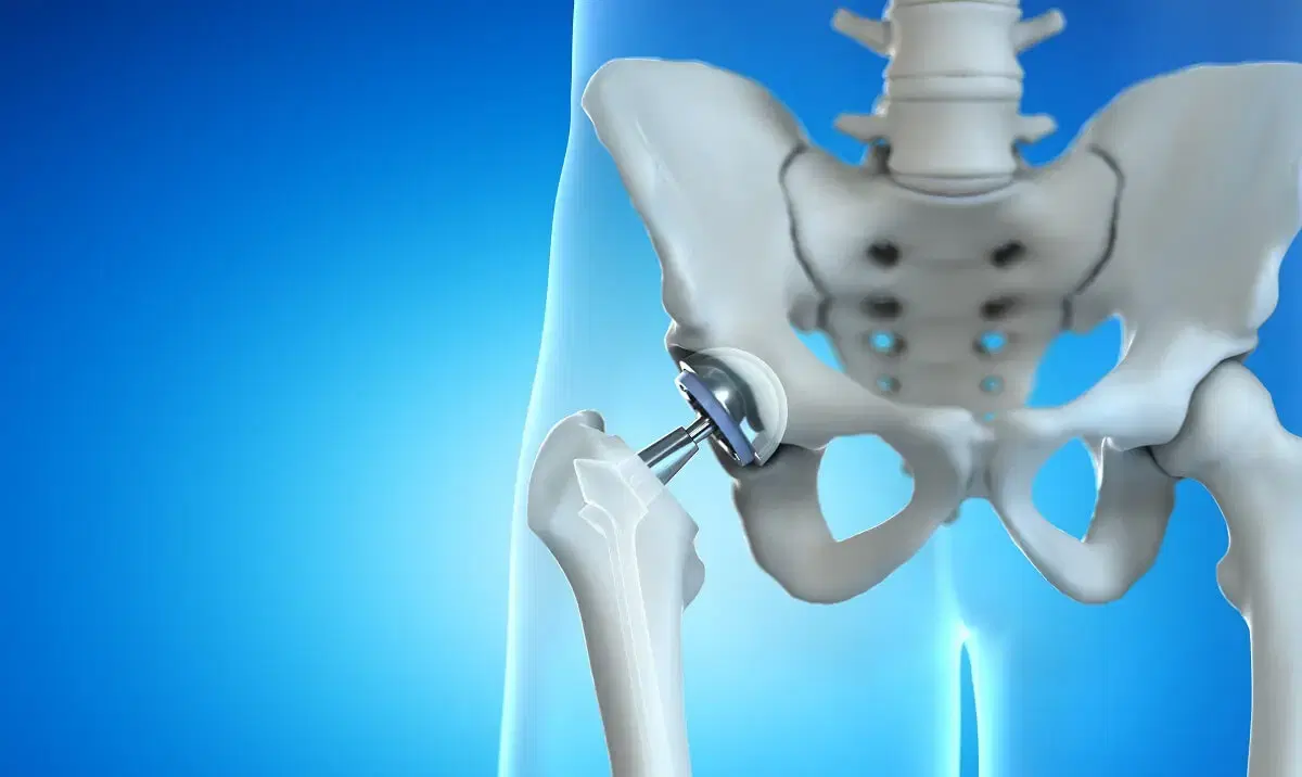 Bilateral Hip Replacement at Artemis, Gurgaon, India