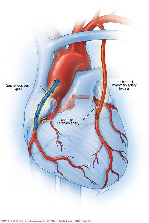 CABG at Medicana Hospital Turkey