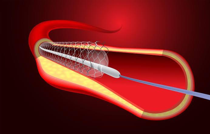 Coronary Angioplasty at Medical Park Istanbul, Turkey