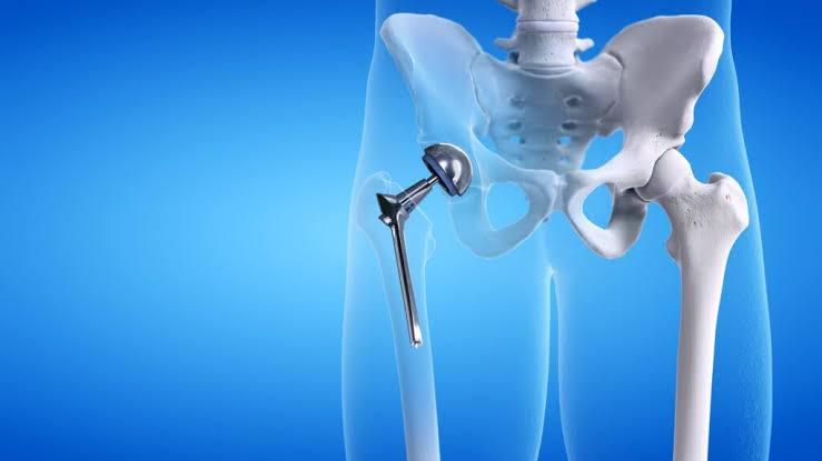 Unilateral Hip Replacement at Global Hospital, Chennai, India