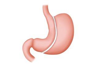 Gastric Bypass Surgery at Asian Institute, Faridabad, India