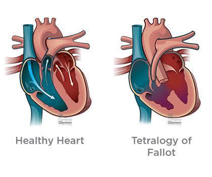 TOF Repair at Paras Hospitals Gurgaon