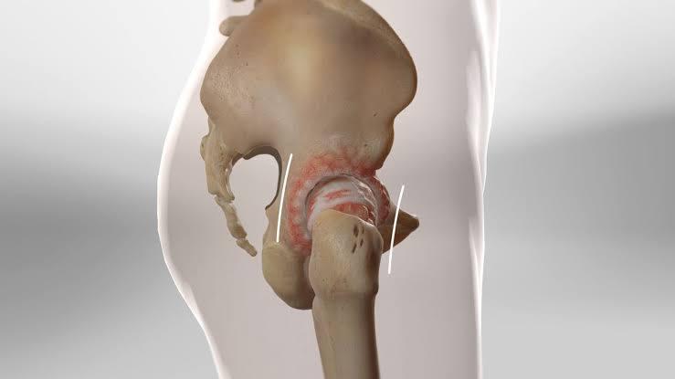 Unilateral Hip Replacement at Medicana Istanbul, Turkey