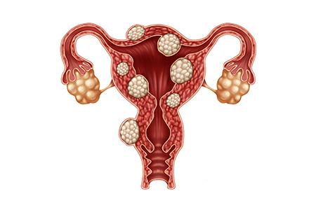 Laparoscopic Myomectomy (Fibroid Removal) at Saudi German Hospital