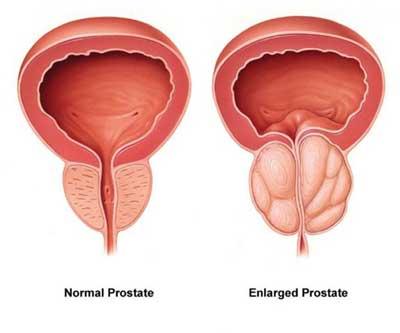 TURP Surgery at Fortis Memorial Research Institute, Gurgaon