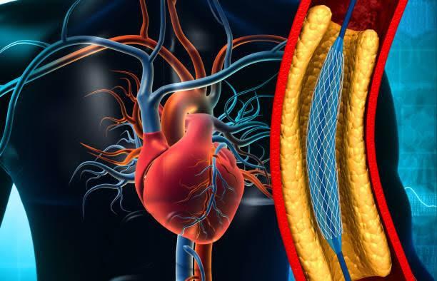 Coronary Angioplasty at Paras Hospital, Gurgaon, India