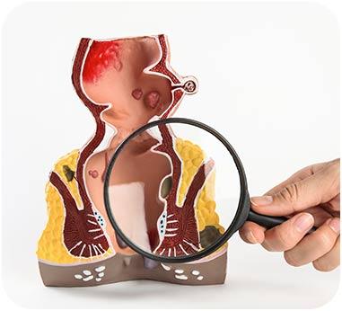 Hemorrhoidectomy Surgery at Medicana Istanbul
